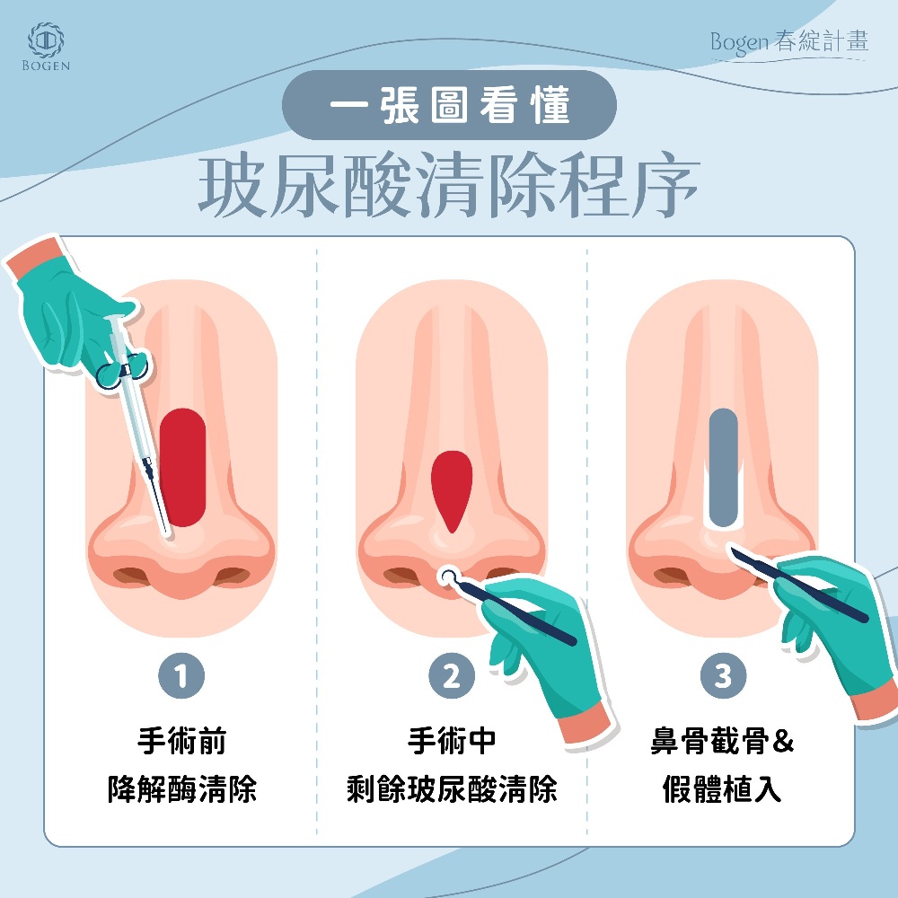 玻尿酸隆鼻清除步驟,玻尿酸隆鼻殘留物清除,玻尿酸隆鼻,博恩妍